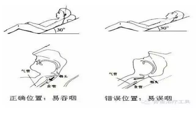卒中吞咽后遗症最好的治疗方法,卒中患者吞咽障碍怎么训练