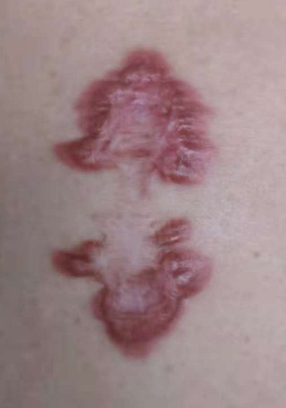 疤痕体质用什么方法祛疤好,欣奕除疤凝胶对疤痕体质有效果吗