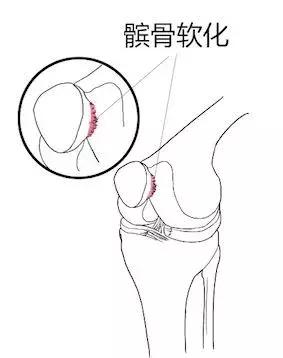 全世界公认膝关节锻炼三个动作,国外康复师康复膝盖的四个动作