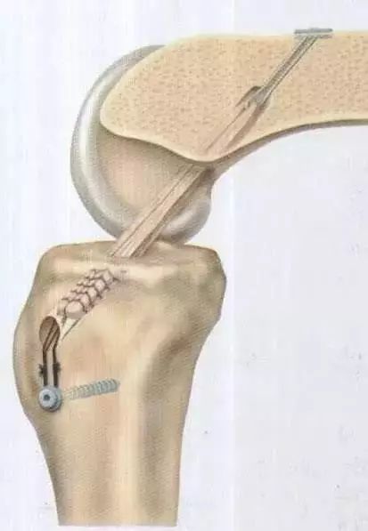 十字韧带断裂多久手术最佳,前交叉十字韧带断裂康复