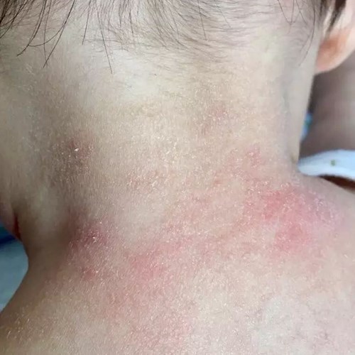 宝宝总是起小疙瘩是怎么回事,宝宝背后小疙瘩怎么解决