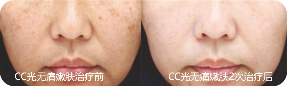 热玛吉仪器打假,热玛吉价格乱象