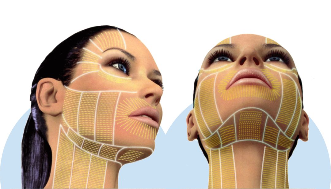 张雨绮说做超声刀就像在烤肉？我去体验了一把……