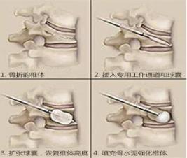 80多岁老太太腰椎疼得厉害,80岁老太太腿疼难忍怎么办