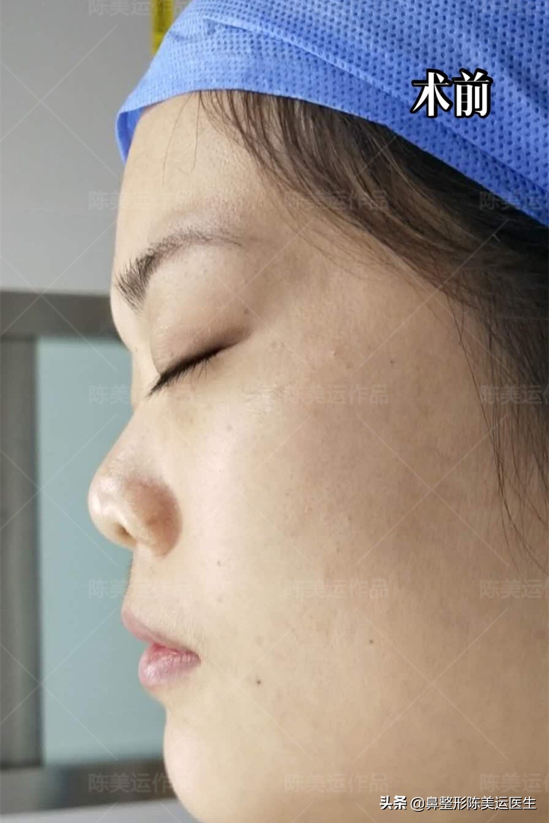 塌鼻子怎么能变成尖鼻子,鼻子太窄太小是不是很难增高鼻梁