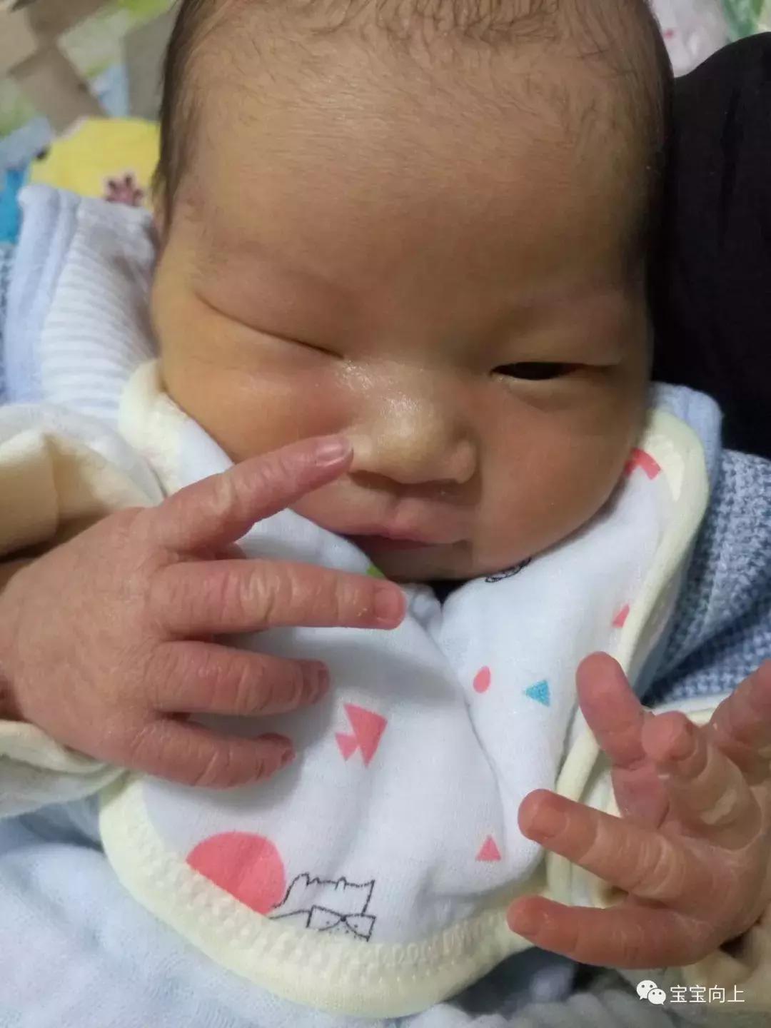哪些偏方可以去黄疸,治疗黄疸一定要停母乳吗