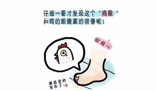鸡眼贴可以把跖疣去掉吗,怎么判断是鸡眼还是跖疣