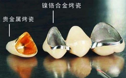 钴铬合金烤瓷牙牙龈变黑怎么处理,烤瓷牙崩瓷了怎么修复