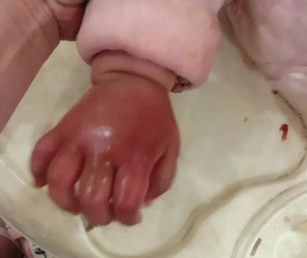 宝宝被蚊虫叮咬最好的解决办法,宝宝被蚊虫叮咬了怎么快速消除