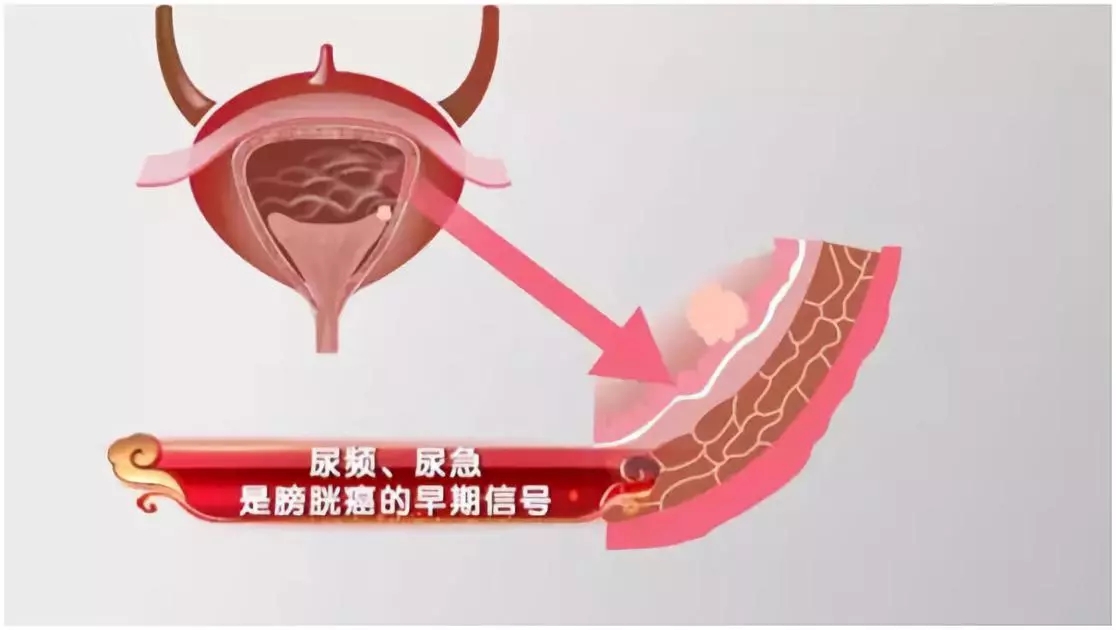 膀胱癌症状无痛血尿,膀胱癌血尿为什么是无痛间歇性