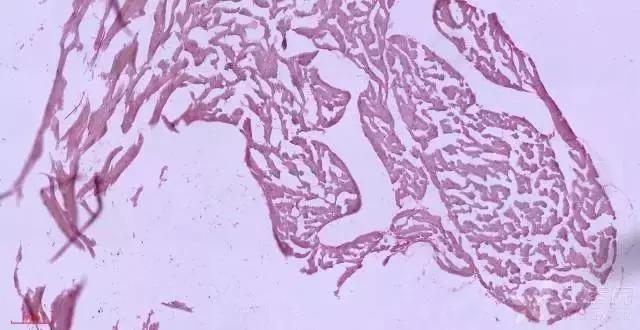 腘绳肌二级拉伤和三级拉伤的区别,大腿内侧拉伤韧带