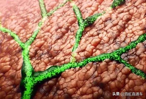 试述pbc与psc的鉴别诊断要点,ps疑难杂症