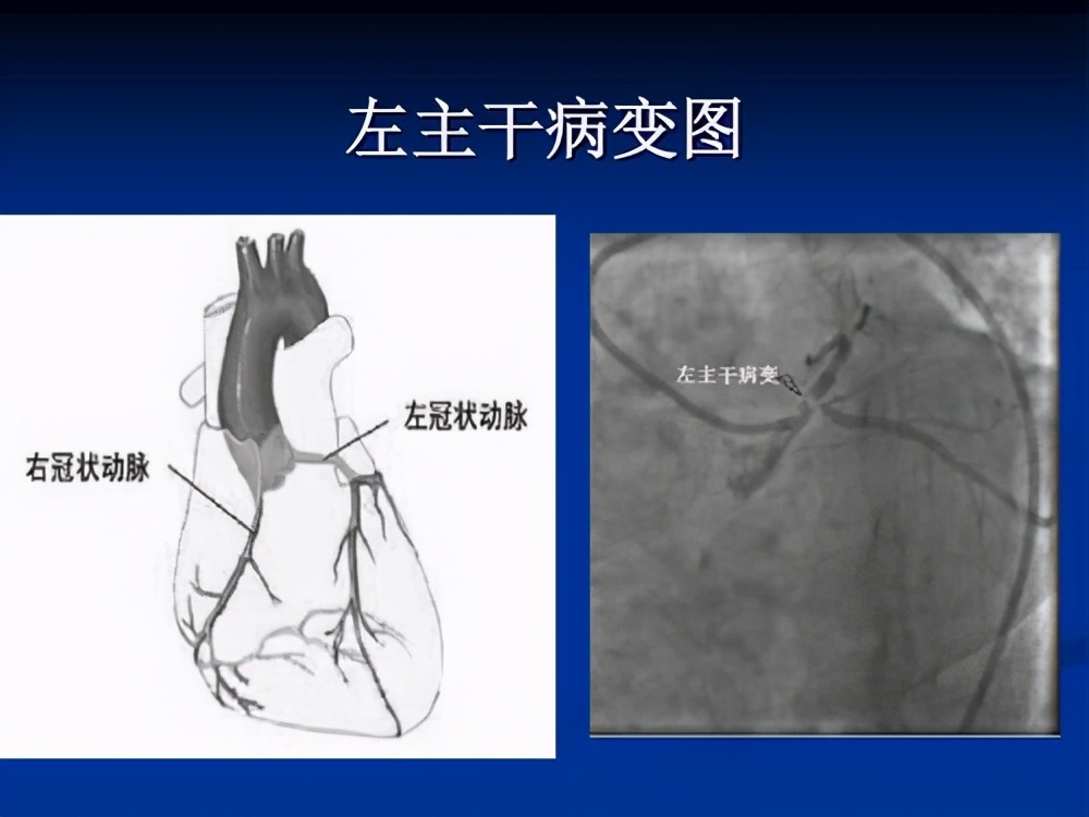 心脏刚下过支架病人应关注什么,刚做完心脏支架还有症状怎么回事