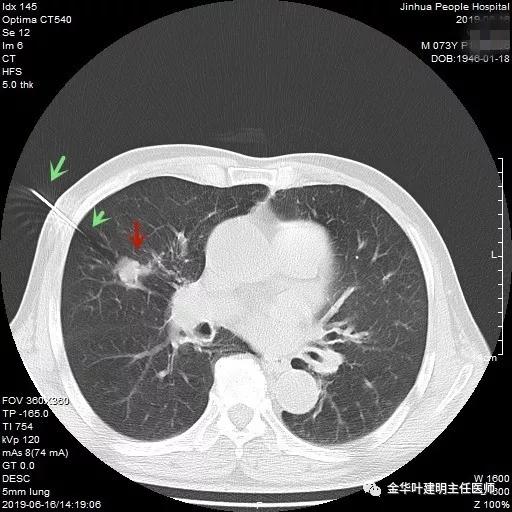 能不能手术,极重度混合性通气功能障碍能治吗