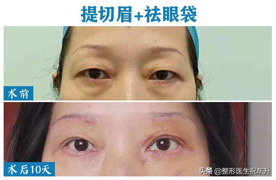 上眼皮松弛的适合做全切手术么,上眼皮松弛去皮了更会显老吗