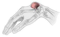 腱鞘囊肿按破了又长出来了怎么办,腱鞘囊肿可以按破吗