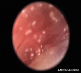 尿酸正常了可以手术取痛风石吗,痛风石可以做手术取掉吗