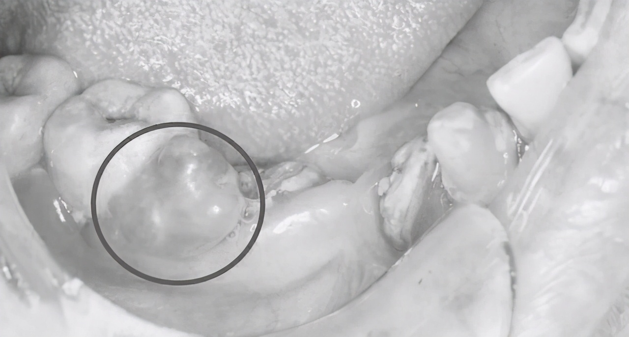 牙龈长硬疙瘩不痛不痒的图片,牙龈疙瘩不痛不痒