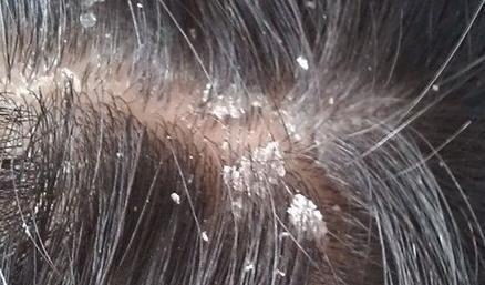 头螨脱发与脂溢性皮炎脱发的区别,脂溢性脱发是脂溢性皮炎引起的吗