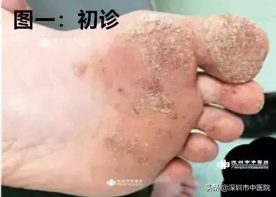 长过趾疣的地方长鸡眼,鹤叔治鸡眼跖疣具体方法