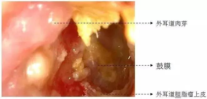 “耳屎”太多被同事吐槽！杭州漂亮姑娘去医院一查，吓得直掉眼泪