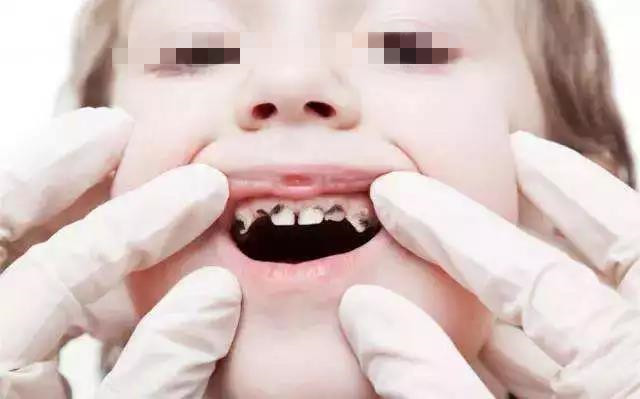 3岁宝宝每天刷牙还有蛀牙,3岁的孩子每天刷牙牙齿还是坏