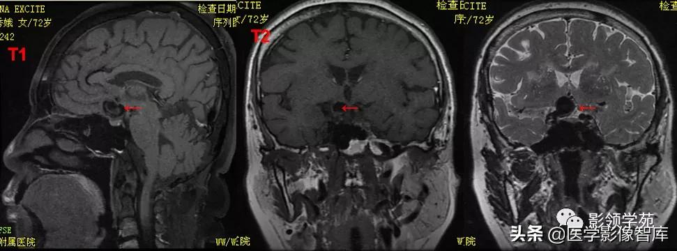 鞍区肿瘤做什么检查得出来,鞍区肿瘤的影像学鉴别
