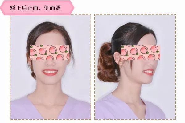 有兔牙如何改善,兔牙怎么矫正