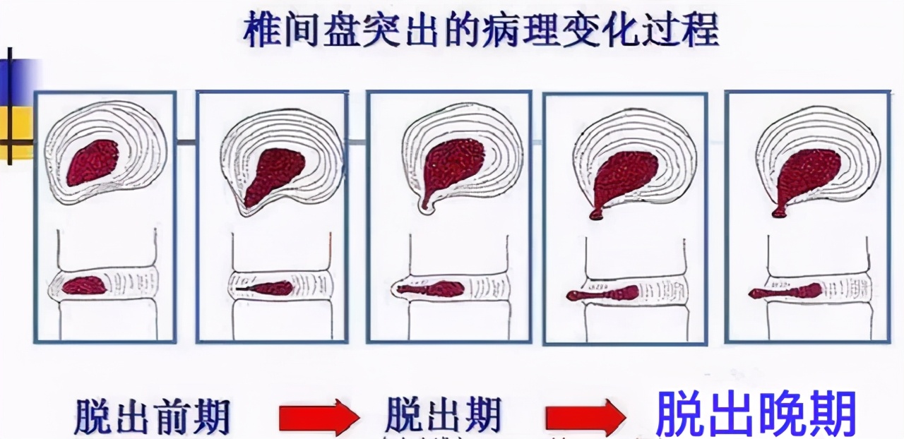 医生总结：椎间盘突出的原因和康复方法，简单实用不说，效果还好