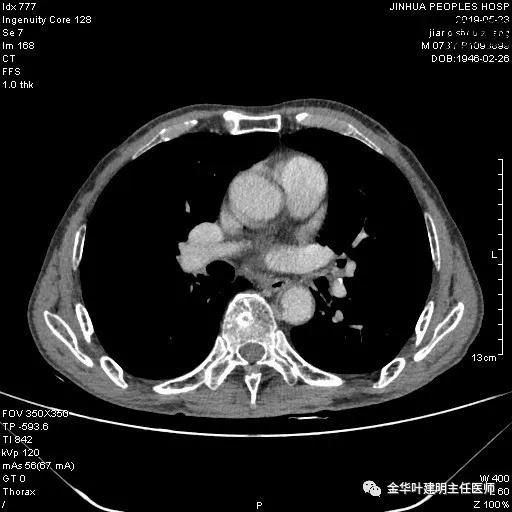 肺手术后乳糜胸是医疗事故吗,肺部切除后乳糜胸治好了