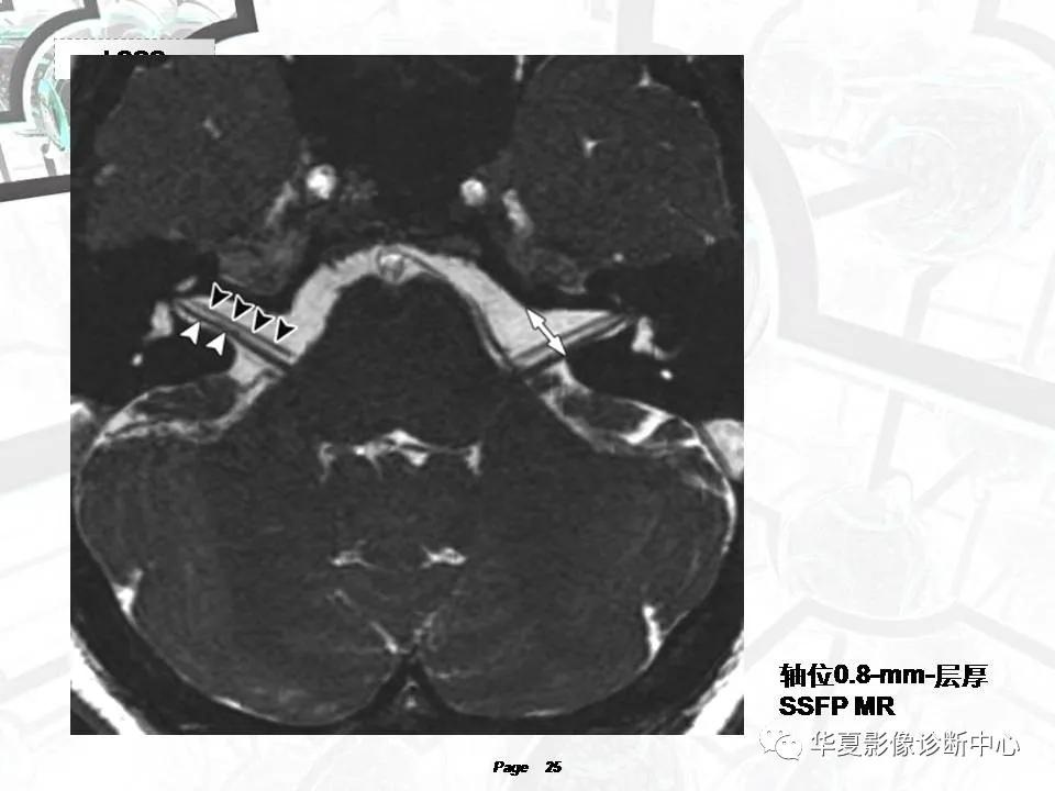 磁共振颅神经扫描是定位在哪,颅神经图谱