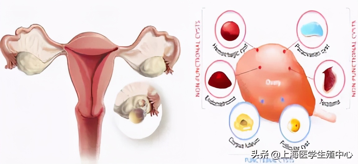 孕三个月卵巢囊肿,卵巢囊肿会影响肺吗