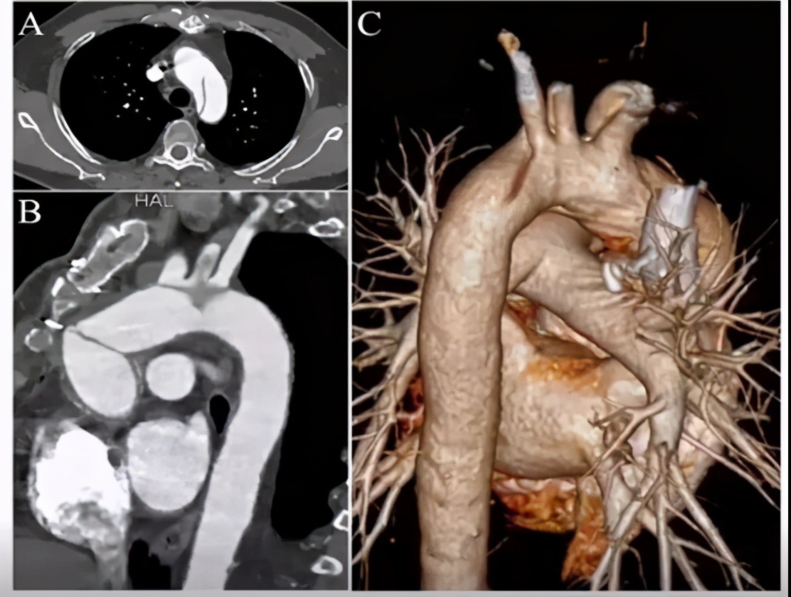 胡佳：升主动脉近端手术后新发弓部病变的腔内治疗