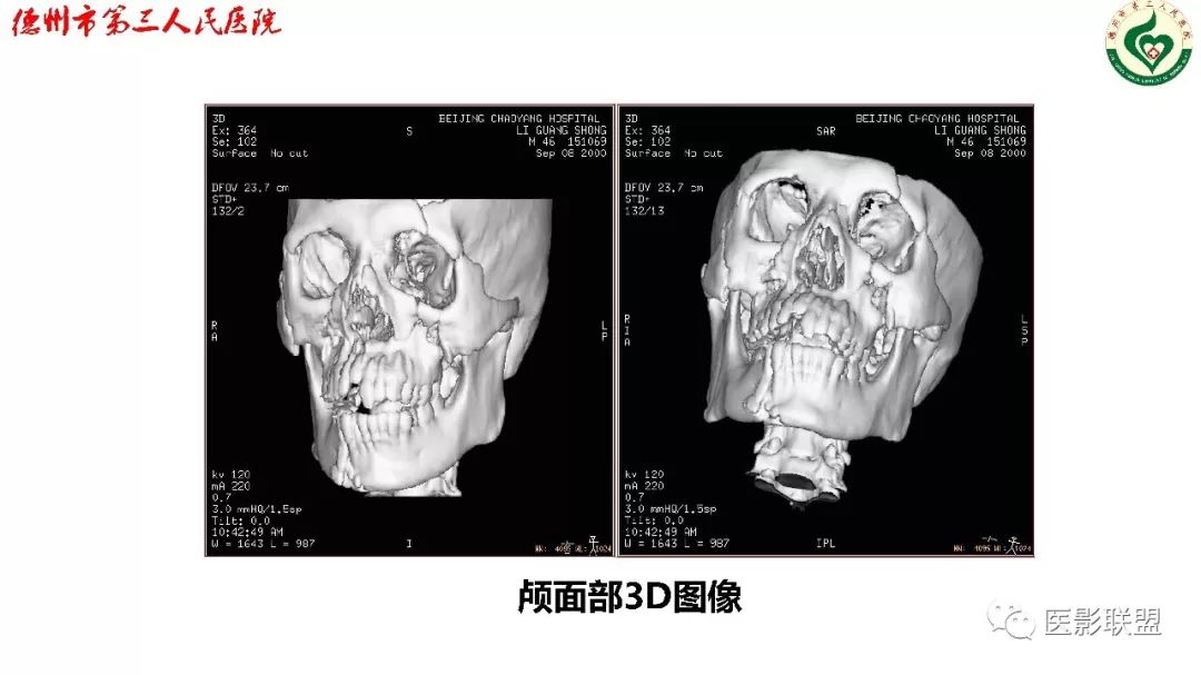 鼻骨骨折影像,鼻骨骨折dr影像表现