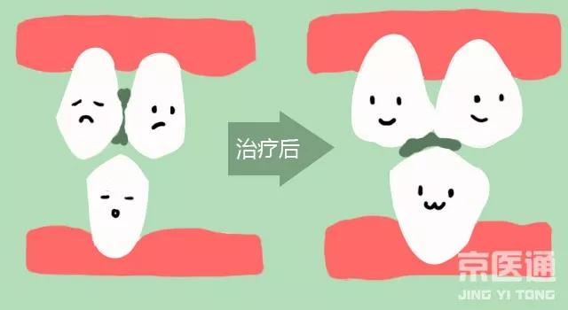 牙缝塞牙用牙签好还是牙线,塞牙了用牙签还是牙线