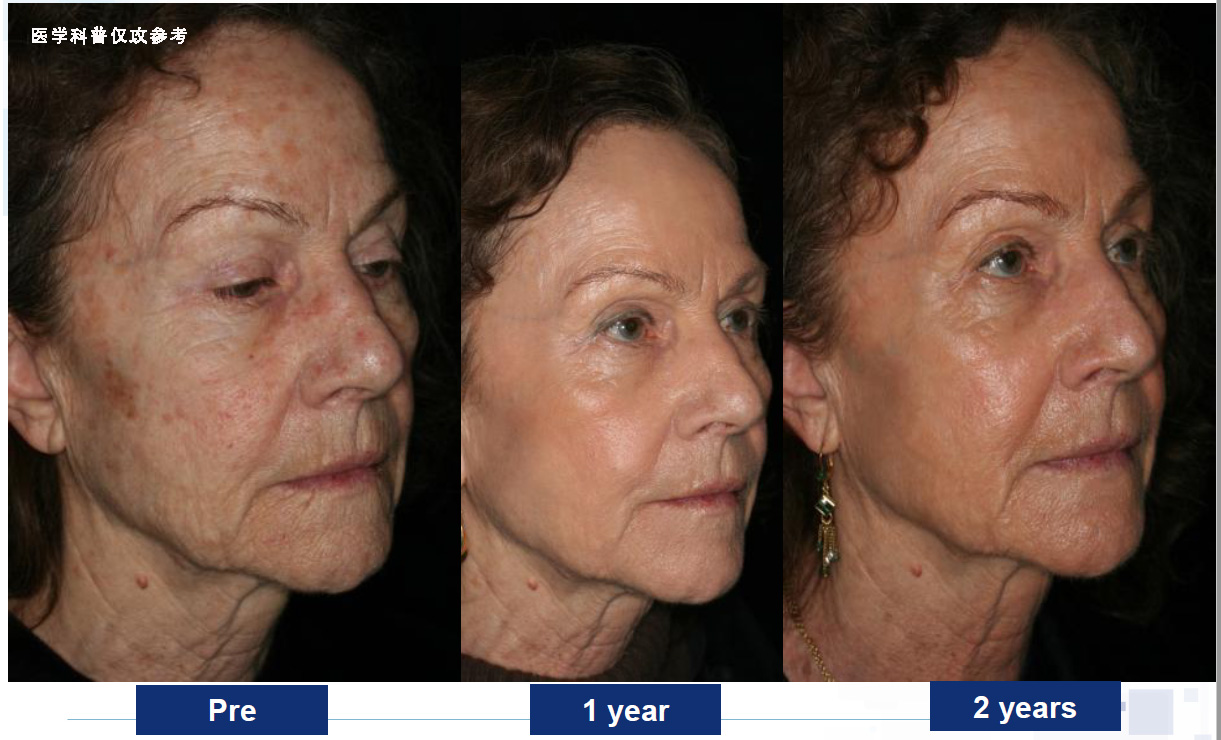 点阵激光的终极效果,超脉冲co2点阵激光效果好吗