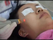 激光美容项目有哪些,激光美容有哪些项目