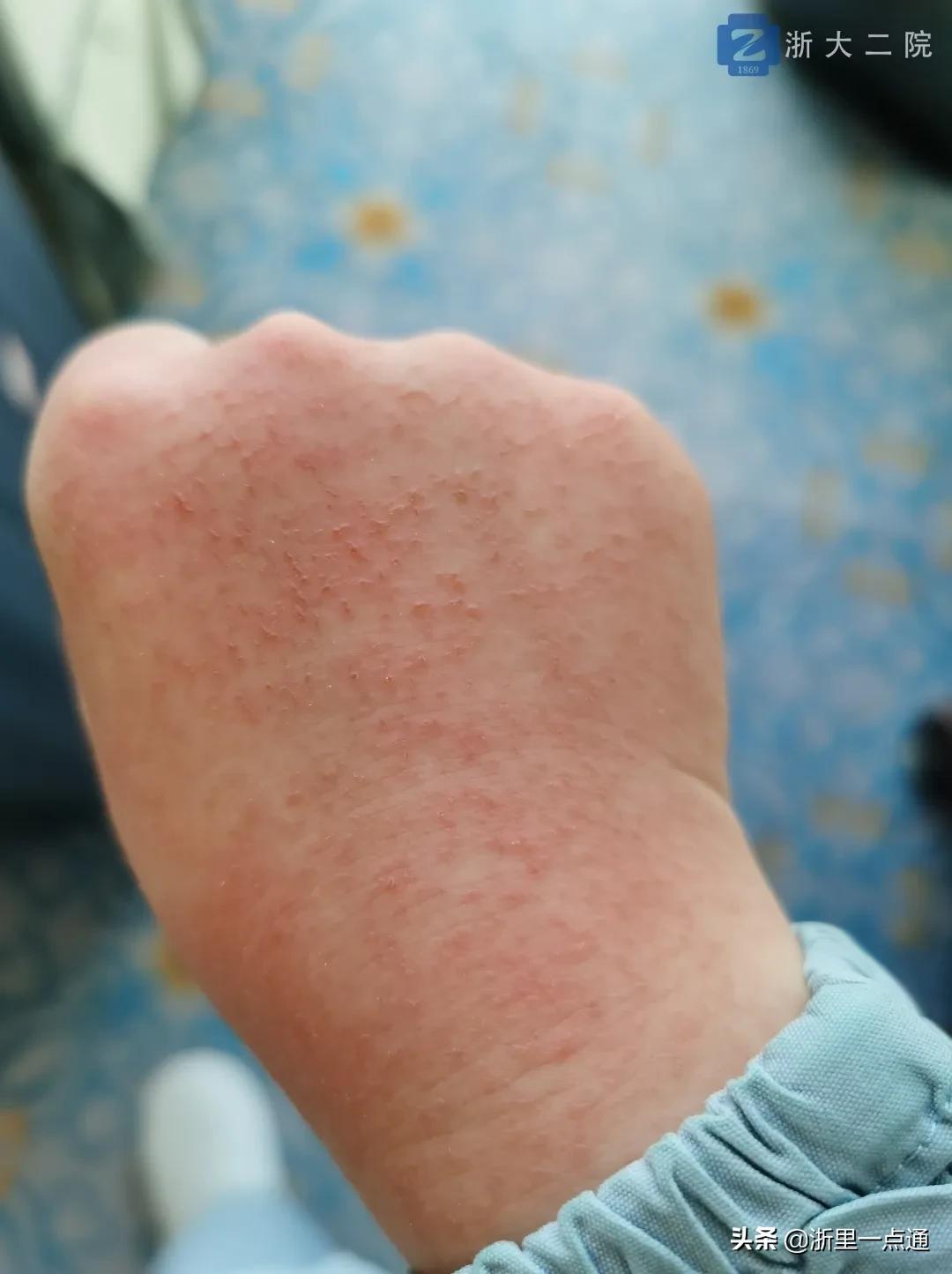 天天戴口罩怎么护肤,天天戴口罩怎么防止冒痘