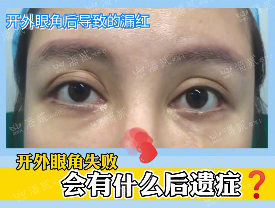 开外眼角结膜充血水肿怎么办,眼睛开外眼角有后遗症吗