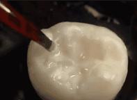 已经有龋齿了还可以做窝沟封闭吗,幼儿龋齿窝沟封闭护理措施