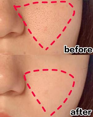 女生闭口粉刺怎么办,有闭口粉刺做什么医美