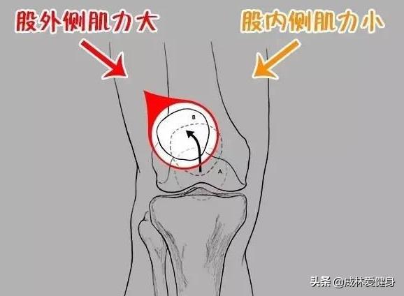 深蹲膝关节弹响怎么解决,深蹲膝关节响