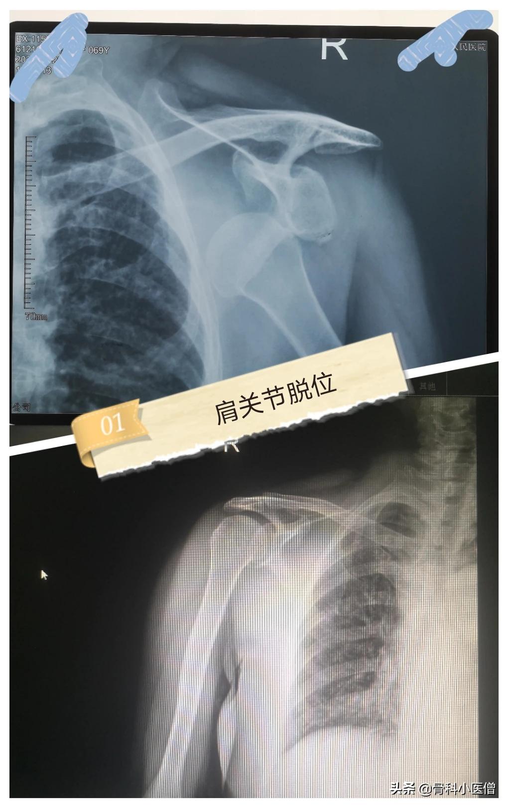 摔倒的肩膀脱位最佳治疗方法,摔了一跤肩袖损伤怎么办