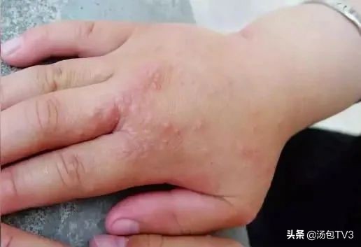 梅雨季皮肤发痒怎么办,梅雨季节皮肤瘙痒怎么回事