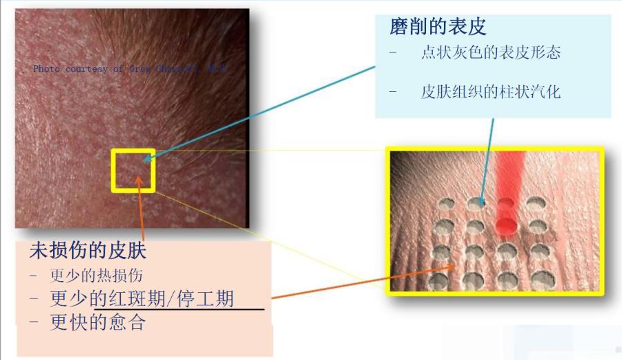点阵激光的终极效果,超脉冲co2点阵激光效果好吗