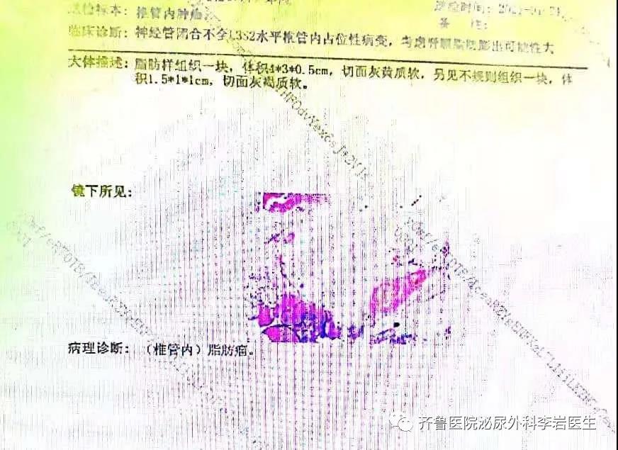 联合疗法治愈他的顽疾-神经源性膀胱