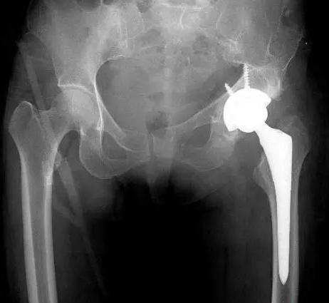 大腿股骨头处疼痛怎么回事,25岁股骨头疼痛什么原因