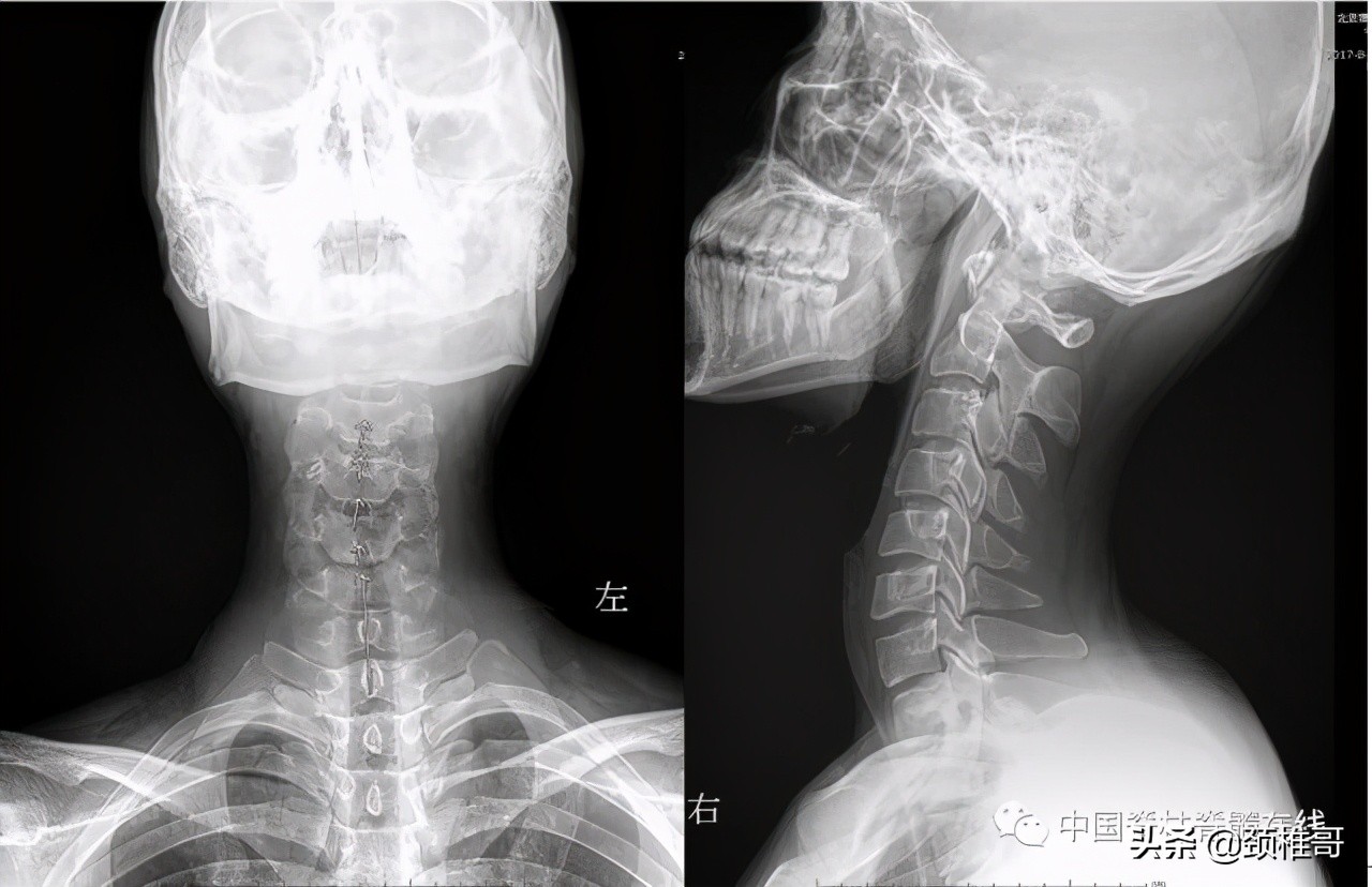 颈椎病的护理临床路径流程图,颈椎病的健康管理与康复指导
