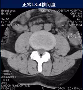 腰椎退行性变腰椎间盘轻度突出,椎间盘突出并膨出继发椎管狭窄