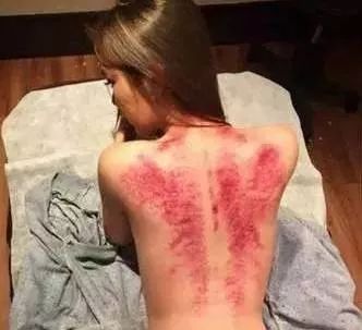 感冒刮痧拔罐的好处和坏处,拔罐刮痧艾灸哪个祛湿气好